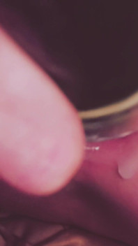 Dilatation Anal