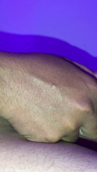 Penis mit viel Haut bedeckt