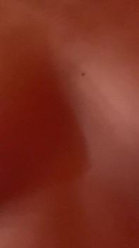 Tillbe mina bröst och bröstvårtor