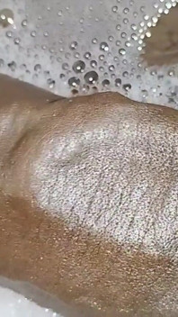 Thick Veins on Cms BBC