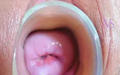 Cervix and Midline Prolapse
