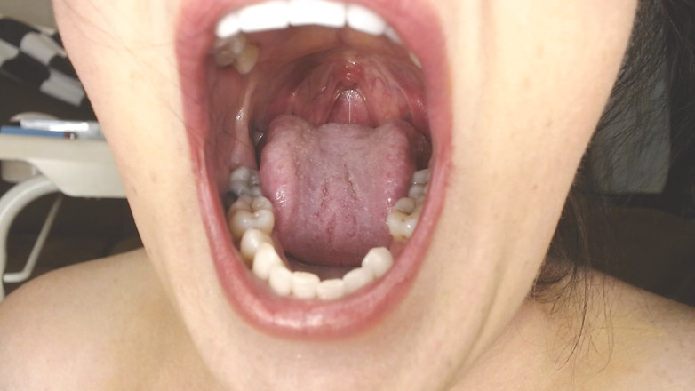 Abby Anna: Dây nhổ vào cổ họng và miệng Uvula Amidan Uvula