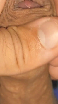 De Grote Transformatie Van Phimosis Elastica.