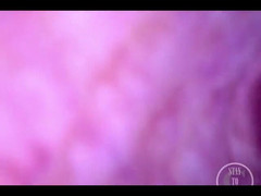 Lina Free: PoV endoscopio catetere inflazione!
