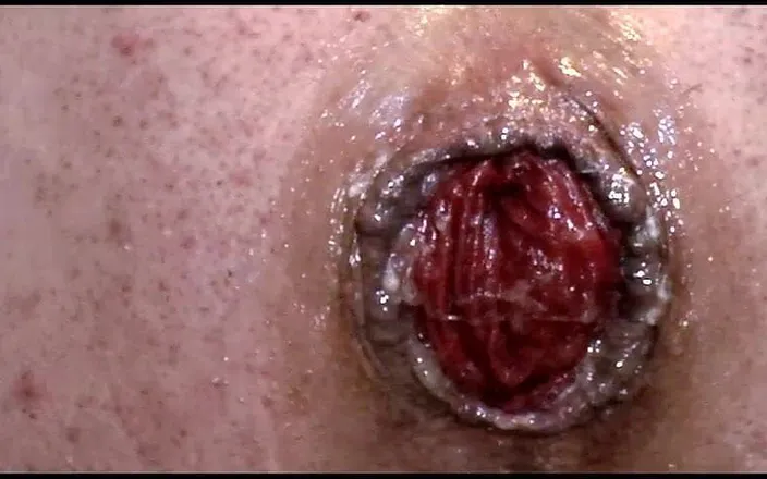 Anita Cocks: Huge Anal Prolapse Pumping 20m