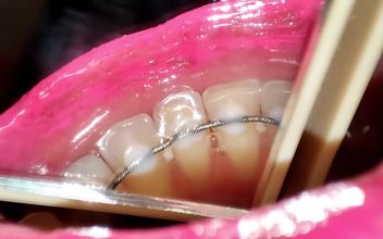 Permanent Retainers Mouth Tour