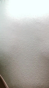 Sẹo sinh mổ 22 năm