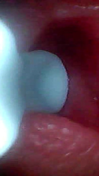 I Couldn’t Believe What Happens Inside the Penis as Sperm Passes Through (endoscopic Footage)
