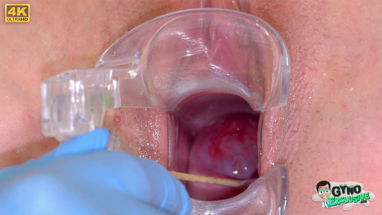 Gyno Exclusive: Silicone Sex Bomb Gets Treatment for Her Irritated Cervix