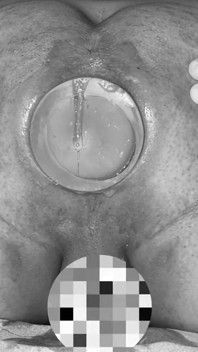 极端肛塞