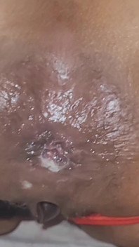 Trying to Get the Sperm Out, It Was so Deep That It Didn't Come Out