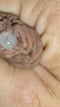 Cumshot of the Largest Phimosis Foreskin in the World.