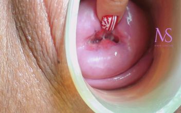 Cervix and Midline Prolapse