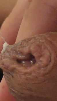 Immense Phimosis Being Extracted Cum and Précum.