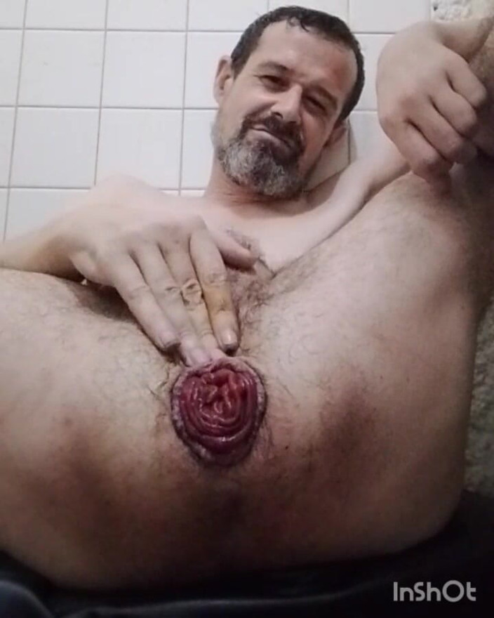 Andres Monoflaco: July Prolapse Progress