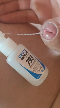 Homemade Self-adhesive Venous Pole Implant!!!