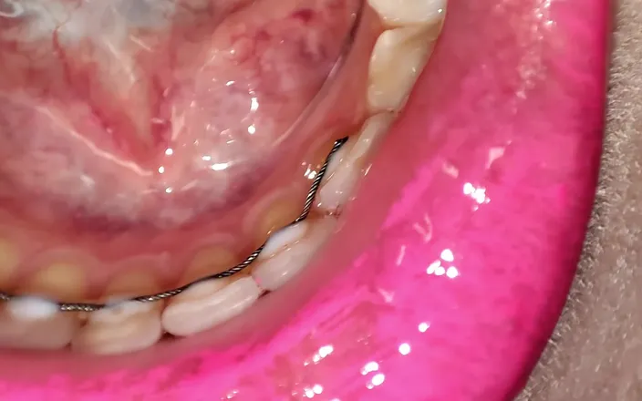 Princess18_: Permanent Retainers Mouth Tour