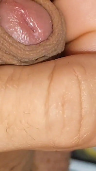 Boy with Large Anal Phimosis Excited!