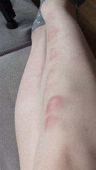 Te Muestro Los Moretones En Mis Piernas Después Del Sexo Duro