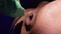 절대 애널 치료